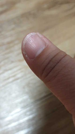 세트 하나로 손발톱 건강걱정 끝내는 위드샨 닥터3종 — 4점을 준 리뷰어가 2020년 1월 올린 사용 사진