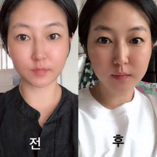 [스케덤] 상악밴드 — 3.5점을 준 리뷰어가 2019년 9월 올린 사용 사진