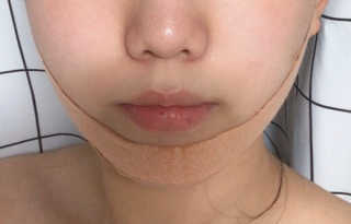 아이디플라코스메틱 아이디 페이스핏 마이너스 밴드 — 5점을 준 리뷰어가 2019년 9월 올린 사용 사진