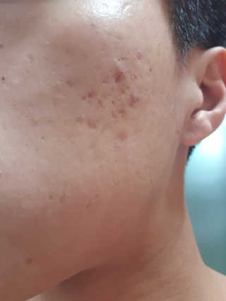 홈메디케어 티트리마스크패드 — 5점을 준 리뷰어가 2018년 5월 올린 사용 사진