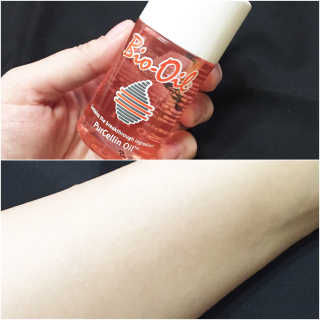 Bio-oil(바이오오일) 바이오오일 — 3.5점을 준 리뷰어가 2016년 10월 올린 사용 사진