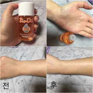 Bio-oil(바이오오일) 바이오오일 — 4.5점을 준 리뷰어가 2016년 10월 올린 사용 사진