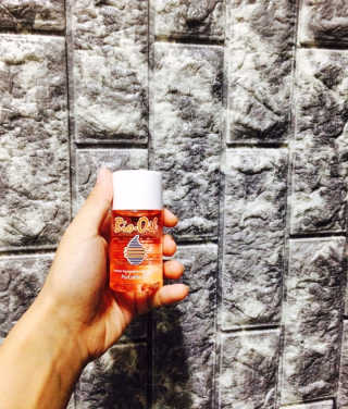 Bio-oil(바이오오일) 바이오오일 — 4.5점을 준 리뷰어가 2016년 10월 올린 사용 사진