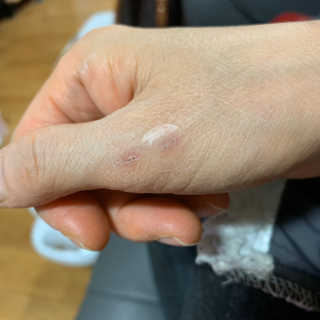 캐치미패치 트러블 스팟패치 — 5점을 준 리뷰어가 2020년 1월 올린 사용 사진