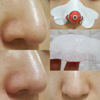 나이팅게일 TAKO PACK NOSE [문어코팩] — 5점을 준 리뷰어가 2017년 5월 올린 사용 사진