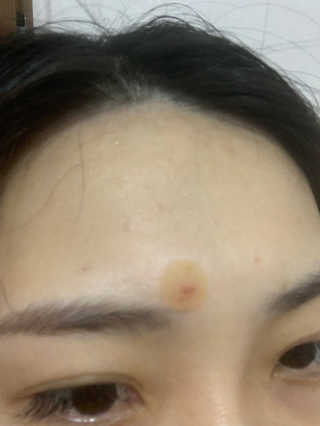 아이디플라코스메틱 아이디 페이스핏 플러스 패치 — 4점을 준 리뷰어가 2019년 10월 올린 사용 사진