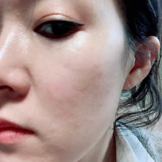 캐치미패치 트러블 스팟패치 — 5점을 준 리뷰어가 2020년 3월 올린 사용 사진