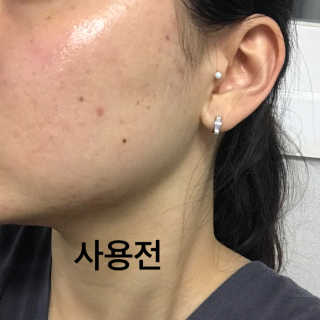 홈메디케어 티트리마스크패드 — 4.33점을 준 리뷰어가 2018년 5월 올린 사용 사진