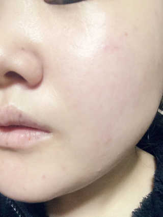 Bio-oil(바이오오일) 바이오오일 — 4.5점을 준 리뷰어가 2016년 10월 올린 사용 사진