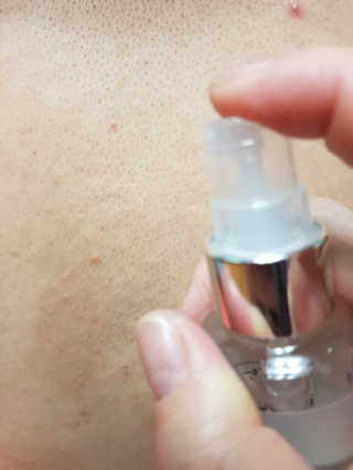 dr.eslee 안티세범 백크네 스프레이 — 5점을 준 리뷰어가 2019년 4월 올린 사용 사진
