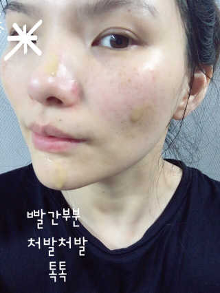 보타니티 [홍]조[진]정[결]케어 플라본 세럼 — 5점을 준 리뷰어가 2018년 5월 올린 사용 사진