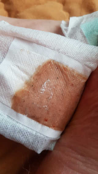 메디테라피 더마 릴렉스 힐링패치 — 5점을 준 리뷰어가 2018년 3월 올린 사용 사진