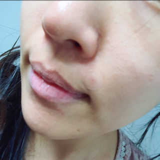 캐치미패치 트러블 스팟패치 — 5점을 준 리뷰어가 2020년 1월 올린 사용 사진