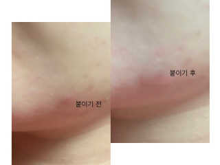 캐치미패치 트러블 스팟패치 — 5점을 준 리뷰어가 2020년 1월 올린 사용 사진