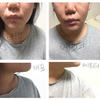 메디미 브이미 업 2스텝 브이라인벨트 — 5점을 준 리뷰어가 2017년 10월 올린 사용 사진