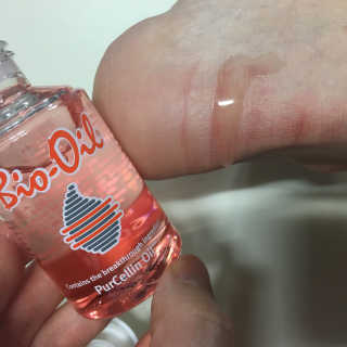 Bio-oil(바이오오일) 바이오오일(Bio-oil) — 5점을 준 리뷰어가 2017년 1월 올린 사용 사진