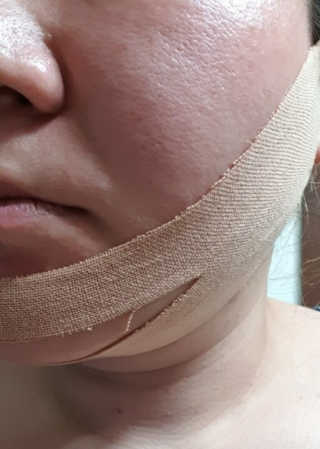 아이디플라코스메틱 아이디 페이스핏 마이너스 밴드 — 4점을 준 리뷰어가 2019년 11월 올린 사용 사진