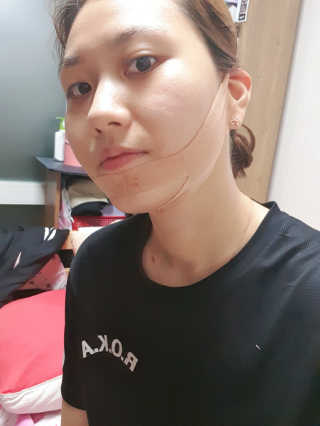 아이디플라코스메틱 아이디 페이스핏 마이너스 밴드 — 4점을 준 리뷰어가 2019년 11월 올린 사용 사진