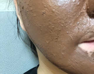 글랜무어 포어 포졸라닉 타이트닝 팩 — 5점을 준 리뷰어가 2019년 11월 올린 사용 사진