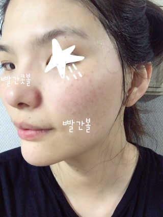 보타니티 [홍]조[진]정[결]케어 플라본 세럼 — 5점을 준 리뷰어가 2018년 5월 올린 사용 사진
