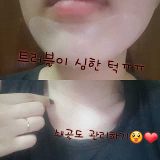 리체 뷰랑셀 케어 스팟 포인트팩 — 4.33점을 준 리뷰어가 2017년 7월 올린 사용 사진