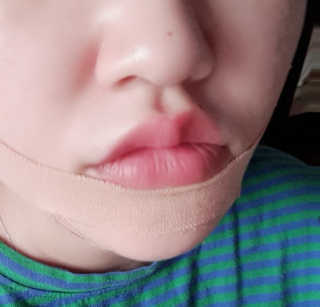아이디플라코스메틱 아이디 페이스핏 마이너스 밴드 — 5점을 준 리뷰어가 2019년 9월 올린 사용 사진
