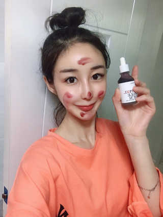 쏘내추럴 레드 필 팅글 세럼 오리지널 — 5점을 준 리뷰어가 2019년 8월 올린 사용 사진