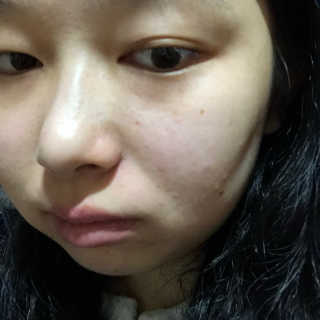 아이소이 불가리안 로즈 블레미쉬 케어 스팟_잡티스팟 — 4점을 준 리뷰어가 2018년 4월 올린 사용 사진