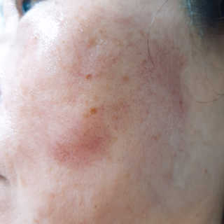 쏘내추럴 레드 필 팅글 세럼 오리지널 — 4.5점을 준 리뷰어가 2019년 8월 올린 사용 사진