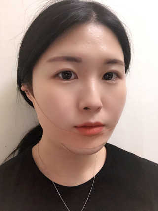 아이디플라코스메틱 아이디 페이스핏 마이너스 밴드 — 5점을 준 리뷰어가 2019년 11월 올린 사용 사진