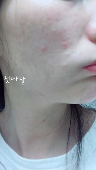 아이소이 파란소화기 응급스팟 — 5점을 준 리뷰어가 2017년 7월 올린 사용 사진