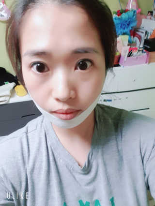 스케덤 클루덤 리프팅 패치 — 3.5점을 준 리뷰어가 2019년 4월 올린 사용 사진