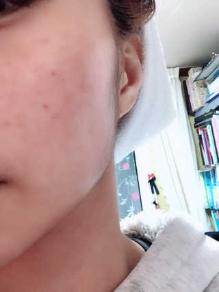 그리니프 얼티밋블레미쉬 솔루션 앰플 30ml — 4점을 준 리뷰어가 2019년 1월 올린 사용 사진
