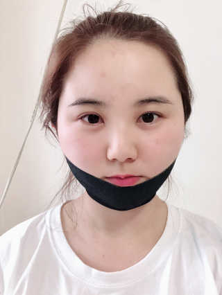 어웨이크어슬립 어슬립 페이스 리프트업 밴드 — 5점을 준 리뷰어가 2018년 7월 올린 사용 사진