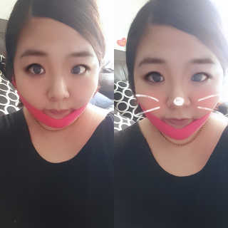 스케덤 펩타이드 리프팅밴드 — 5점을 준 리뷰어가 2019년 3월 올린 사용 사진