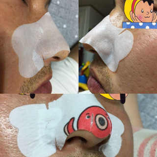 나이팅게일 TAKO PACK NOSE [문어코팩] — 3점을 준 리뷰어가 2017년 6월 올린 사용 사진