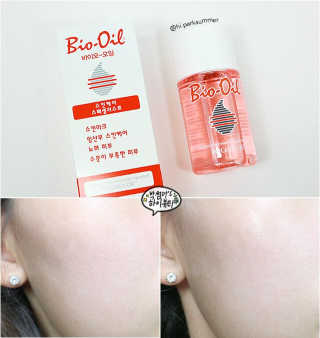 Bio-oil(바이오오일) 바이오오일 — 3점을 준 리뷰어가 2016년 10월 올린 사용 사진