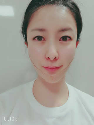 아이디플라코스메틱 아이디 페이스핏 마이너스 밴드 — 5점을 준 리뷰어가 2019년 11월 올린 사용 사진