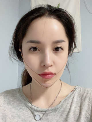아이디플라코스메틱 아이디 페이스핏 마이너스 밴드 — 5점을 준 리뷰어가 2019년 10월 올린 사용 사진