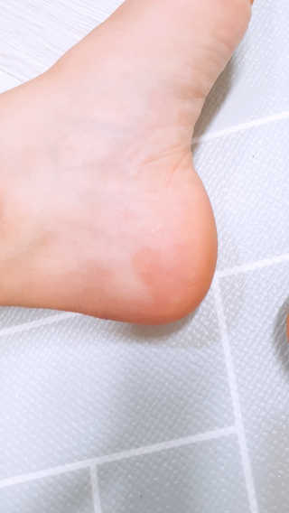 클린앤블락 클린풋 각질 솔루션 — 5점을 준 리뷰어가 2019년 7월 올린 사용 사진