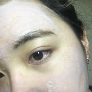 셀퓨전씨 트리악 포어 딜리트 버블 팩 — 5점을 준 리뷰어가 2018년 4월 올린 사용 사진