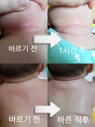엘루스벤 에코스토어_네피밤 땀띠크림 — 5점을 준 리뷰어가 2017년 8월 올린 사용 사진