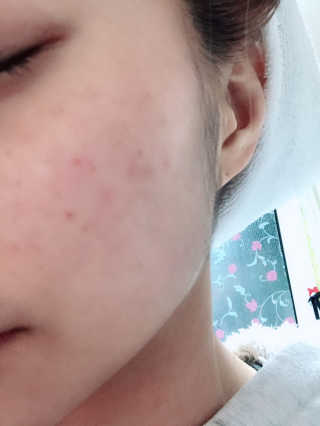 그리니프 얼티밋블레미쉬 솔루션 앰플 30ml — 4점을 준 리뷰어가 2019년 1월 올린 사용 사진