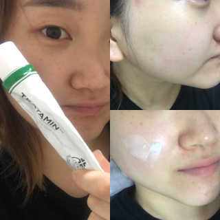 나이팅게일 티타민 크림 리뉴얼 — 4.33점을 준 리뷰어가 2018년 4월 올린 사용 사진