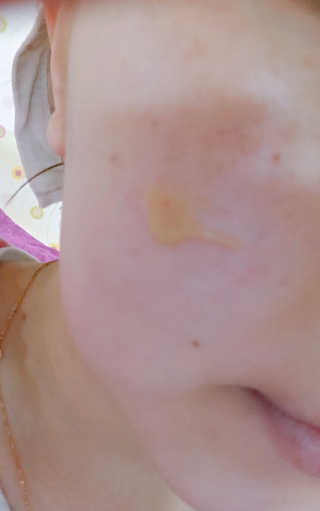 보타니티 [홍]조[진]정[결]케어 플라본 세럼 — 5점을 준 리뷰어가 2018년 5월 올린 사용 사진