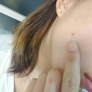 본비반트 티 솔루션 안티 블레미쉬 스팟 에센스 — 3점을 준 리뷰어가 2017년 3월 올린 사용 사진