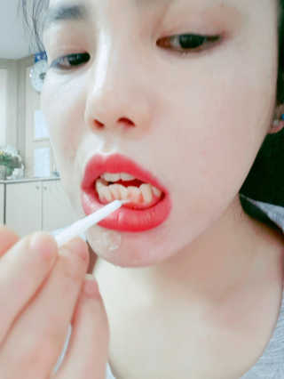 충치예방 집에서하는 불소도포 덴티스랩 쉴드 — 3.67점을 준 리뷰어가 2018년 6월 올린 사용 사진