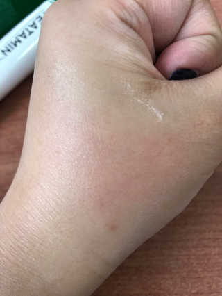 나이팅게일 티타민 크림 리뉴얼 — 5점을 준 리뷰어가 2018년 4월 올린 사용 사진