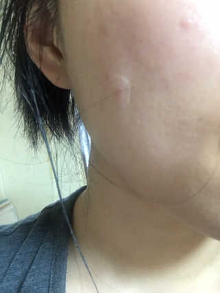 캐치미패치 트러블 스팟패치 — 4점을 준 리뷰어가 2019년 12월 올린 사용 사진