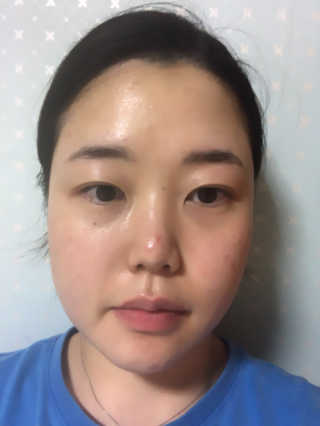 스케덤 펩타이드 리프팅밴드 — 4점을 준 리뷰어가 2019년 6월 올린 사용 사진